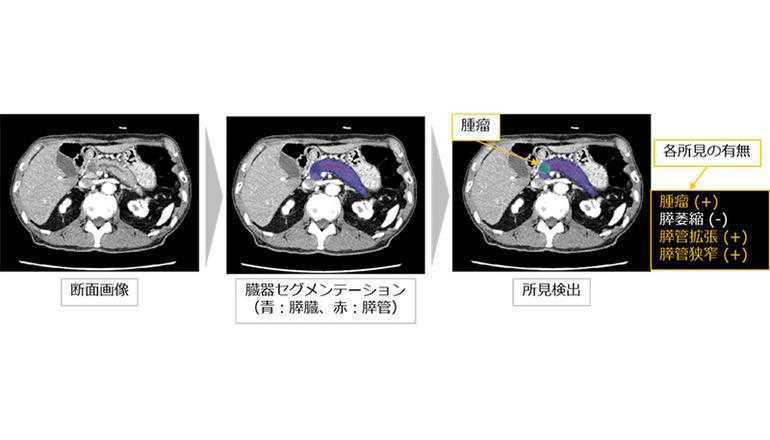 医療DX、造影CT画像とAIにて膵臓の腫瘤および間接所見を検出