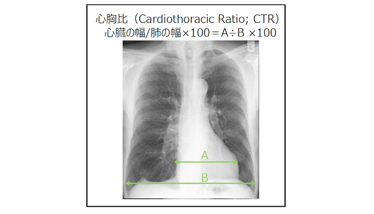 経年的な胸部レントゲン写真のCTRから心不全発症リスクを明らかに